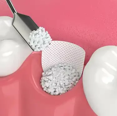 Smile Dental Clinic: Bone Graft Dentist Dr. Ana Fusu Dr. Fusu