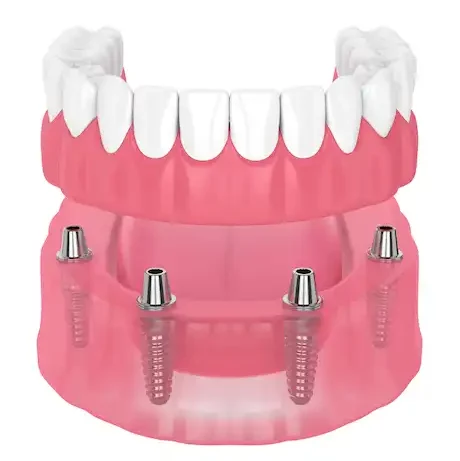Smile Dental Clinic: Complete Dentures Dentist Dr. Ana Fusu Dr. Fusu