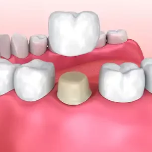 Smile Dental Clinic: Dental Crown Dentist Dr. Ana Fusu Dr. Fusu