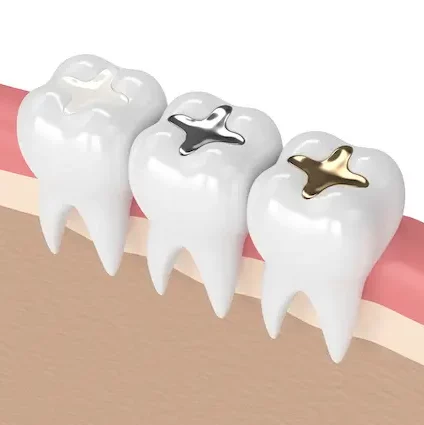 Model Showing Dental Fillings