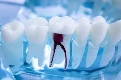Dental model showing tooth root canal