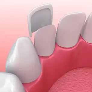 Smile Dental Clinic: Dental Veneers Dentist Dr. Ana Fusu Dr. Fusu