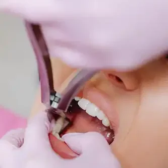 Smile Dental Clinic: Extractions Dentist Dr. Ana Fusu Dr. Fusu