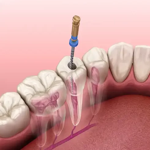 Smile Dental Clinic: Root Canal Dentist Dr. Ana Fusu Dr. Fusu
